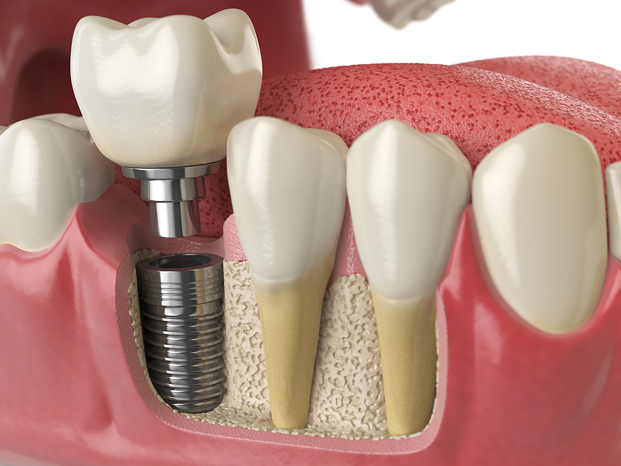 Revitalize Your Smile with Dental Implants