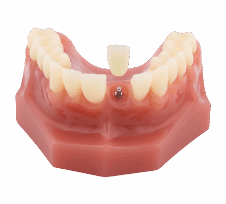 Mini Dental Implants in Lincolnwood, IL | Book a Free Consultation