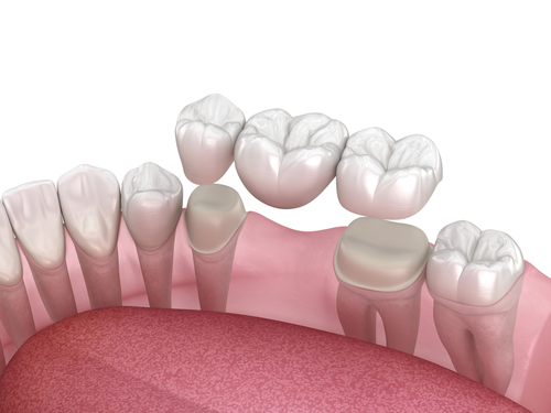 Dental Bridge in Lincolnwood, IL | Replace Missing Teeth Affordably