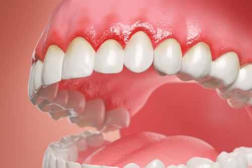 Reverse-Gum-Disease-Program-without-Surgery