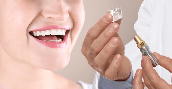 Puente dental vs. implante en Lincolnwood, IL: una guía clara para tomar una decisión