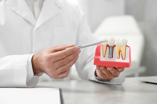 Miniimplantes dentales frente a implantes tradicionales en Lincolnwood, IL